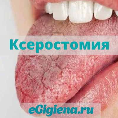 Ксеростомия (сухость в полости рта)
